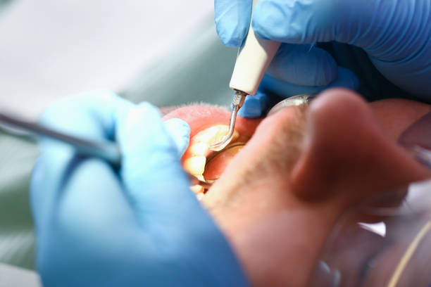 Best Emergency Dentist for Knocked-Out Tooth in Lafayette, OR