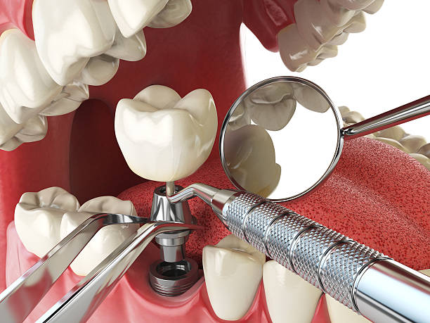 Best Broken or Cracked Tooth Emergency Dentist in Lafayette, OR